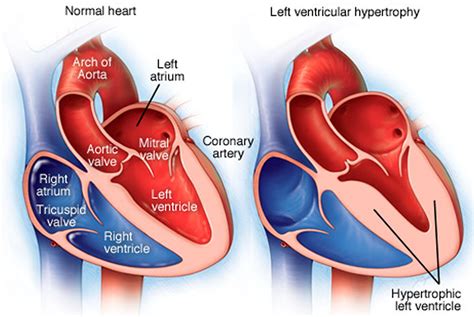 eccentric hypertrophy of left ventricle.